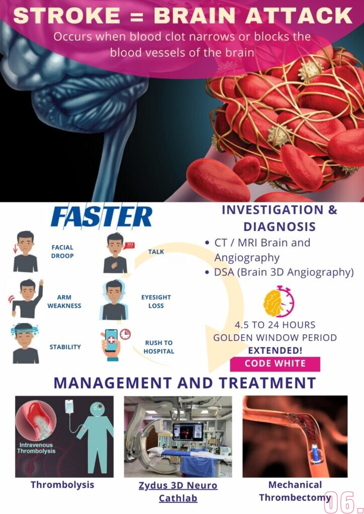 Stroke Symptoms And Treatment Center In Ahmedabad Udaipur Bhilwara Jodhpur Surat Gujarat 0440